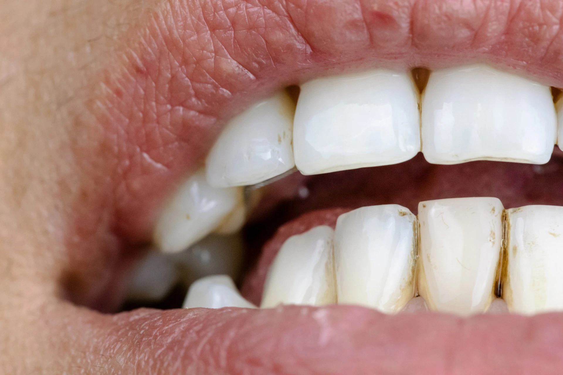 <strong>Diabetes mellitus e saúde oral</strong>