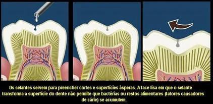 aplicação de selantes