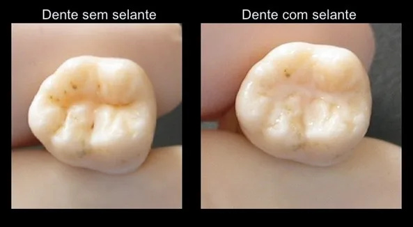 dentes