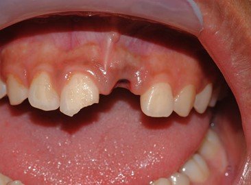 dente