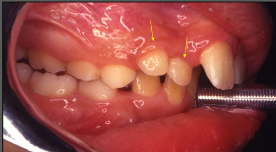 dentes supranumerários - dentes a mais