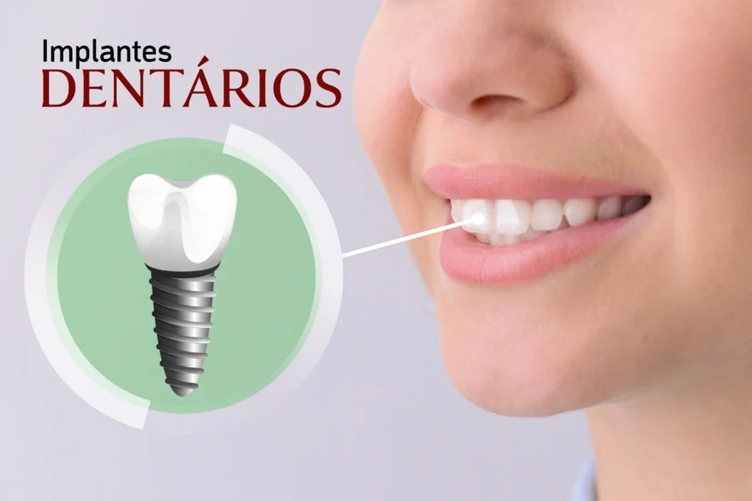 <strong>Vantagens do tratamento com implantes</strong>
